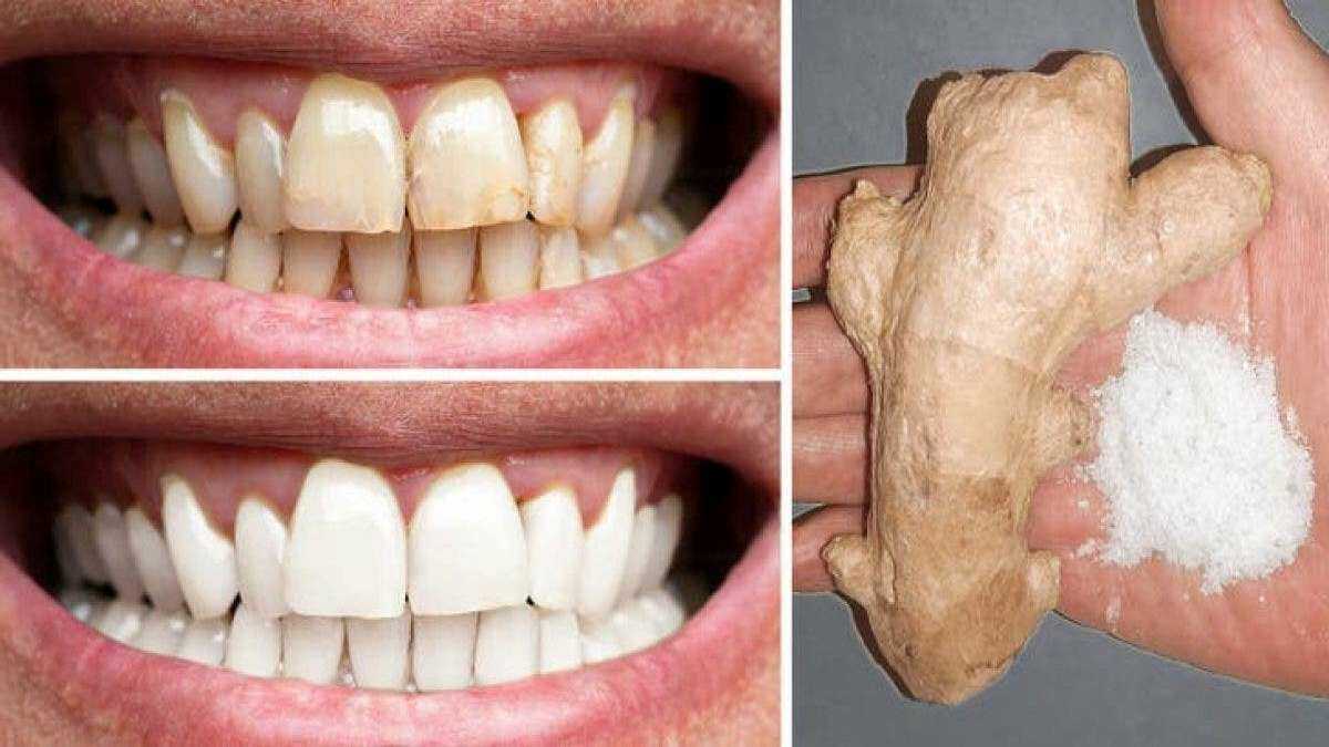 Gingembre, sel permettent de blanchir les dents comment les utiliser