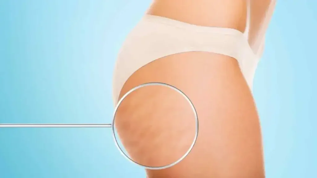 6 Exercices Faciles Pour Perdre Sa Cellulite En Seulement 2 Semaines.