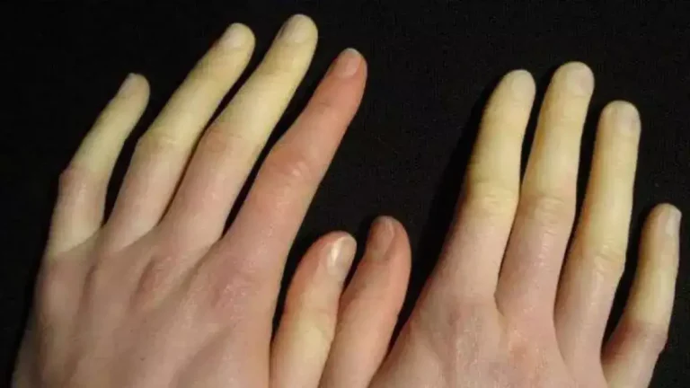 Pieds et mains froids, couleur changeante : Le syndrome de Raynaud est très courant, mais peu de gens le connaissent