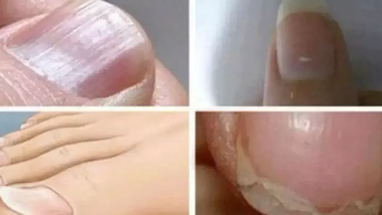 Les meilleurs remèdes maison pour atténuer une infection des ongles